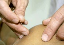 Acupuncture